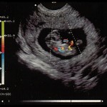 Doppler Ultrasound Scan