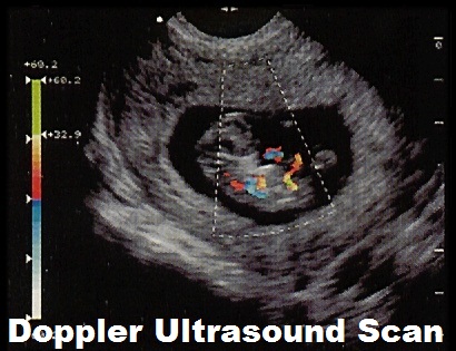 What is a Doppler Ultrasound Scan