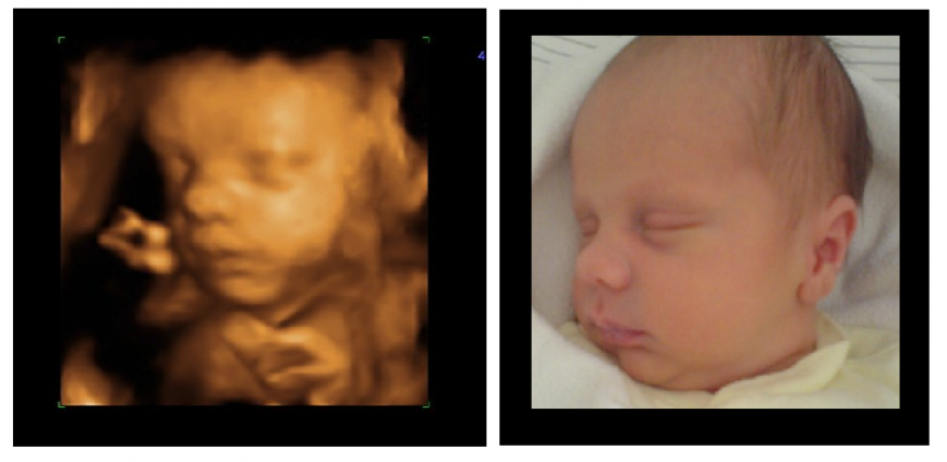 Baby Scan Picture Compared With Picture of Baby Born